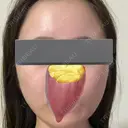 その他（肌） / ピーリング（ハリ・ツヤ） 東京シンデレラ美容外科 大宮院 DAY 2 サムネイル用