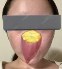 その他（肌） / ピーリング（ハリ・ツヤ） 東京シンデレラ美容外科 大宮院 DAY 3 サムネイル用