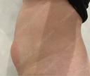 脂肪冷却（お腹） MIO CLINIC 梅田院 DAY 1 サムネイル用