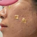 ほくろ・いぼ切除（肌） R Beauty CLINIC 名古屋院 AFTER サムネイル用