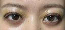 自然癒着法 / 眼瞼下垂（非切開） LUHO（ルホ）美容外科 DAY 3 サムネイル用