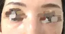 スネコス PRISM Beauty Clinic 町田院 AFTER サムネイル用