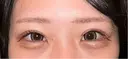 クマ治療 R Beauty CLINIC 銀座院 AFTER サムネイル用
