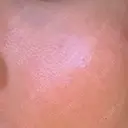 その他（肌） YAYOI CLINIC DAY 7 サムネイル用