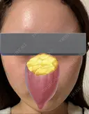 その他（肌） / ピーリング（ハリ・ツヤ） 東京シンデレラ美容外科 大宮院 AFTER サムネイル用