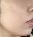 RF（高周波）たるみ治療 東京美容医療クリニック 池袋院 DAY 1 サムネイル用