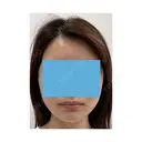 切開リフト 東京エビスクリニック AFTER サムネイル用