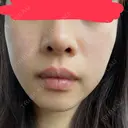 イオン導入 / ピーリング（ハリ・ツヤ） / ルメッカ ルラ美容クリニック 札幌本院 AFTER サムネイル用