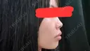 ボトックス（首） / ヒアルロン酸注入（鼻翼基部） KAGA CLINIC DAY 0 サムネイル用