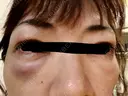 その他（目元） / クマ治療 / 上まぶたの脂肪取り / ヒアルロン酸注入（目の下） ROOTS Clinic DAY 1 サムネイル用