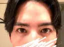 二重埋没 シェリークリニック 新宿本院 AFTER サムネイル用