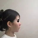 隆鼻術 / 鼻中隔延長（切開） / 鼻翼基部形成（貴族手術） ヴェリテクリニック 銀座院 DAY 264 サムネイル用