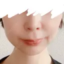 ボトックス（エラ・小顔） 共立美容外科 梅田院 AFTER サムネイル用