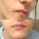 医療脱毛（顔） Lumiera Clinic DAY 1 サムネイル用