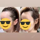 アートメイク（唇） / アートメイク（ヘアライン） Jfeel（ジェイフィール）クリニック-ホンデ院 DAY 0 サムネイル用