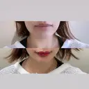 アートメイク（唇） / アートメイク（ヘアライン） Jfeel（ジェイフィール）クリニック-ホンデ院 DAY 0 サムネイル用