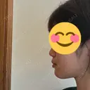 ヒアルロン酸注入（あご） ヴェリテクリニック 大阪院 AFTER サムネイル用