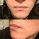 医療脱毛（顔） Lumiera Clinic AFTER サムネイル用