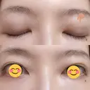 二重埋没 / 上まぶたの脂肪取り THE FIRST CLINIC 多摩センター院 DAY 26 サムネイル用