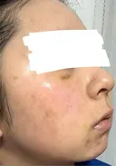 水光注射（ハリ・美肌） ARTE BEAUTY CLINIC DAY 5 サムネイル用