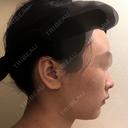 バッカルファット除去 / 脂肪吸引（顔） / ヒアルロン酸注入（鼻） / ボトックス（あご） / 水光注射（ハリ・美肌） / ボトックス（エラ・小顔） / ボトックス（口角） / 白玉点滴・注射 エートップ美容整形外科 DAY 22 サムネイル用