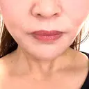 糸リフト / 脂肪吸引（顔） Tokyo Tensei Clinic 新宿院 DAY 6 サムネイル用