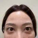 クマ治療 / スネコス PRISM Beauty Clinic 町田院 DAY 1 サムネイル用