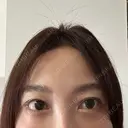 クマ治療 / スネコス PRISM Beauty Clinic 町田院 DAY 2 サムネイル用