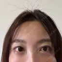 クマ治療 / スネコス PRISM Beauty Clinic 町田院 DAY 3 サムネイル用