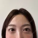 クマ治療 / スネコス PRISM Beauty Clinic 町田院 DAY 4 サムネイル用
