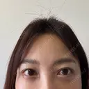 クマ治療 / スネコス PRISM Beauty Clinic 町田院 DAY 5 サムネイル用