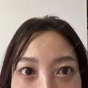 クマ治療 / スネコス PRISM Beauty Clinic 町田院 DAY 7 サムネイル用