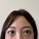 クマ治療 / スネコス PRISM Beauty Clinic 町田院 DAY 8 サムネイル用