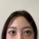 クマ治療 / スネコス PRISM Beauty Clinic 町田院 AFTER サムネイル用