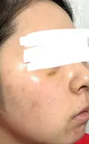 水光注射（ハリ・美肌） ARTE BEAUTY CLINIC DAY 6 サムネイル用