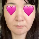 糸リフト / 脂肪吸引（顔） / メーラーファット除去 / ジョールファット除去 湘南美容クリニック 秋葉原院 DAY 230 サムネイル用