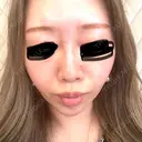 ヒアルロン酸注入（鼻） / ヒアルロン酸注入（あご） / ボトックス（眉間） 共立美容外科 福岡院 DAY 0 サムネイル用