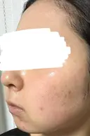 水光注射（ハリ・美肌） ARTE BEAUTY CLINIC DAY 7 サムネイル用