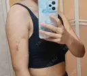 脂肪吸引（二の腕） アムルーズ美容外科クリニック 大阪院 DAY 14 サムネイル用