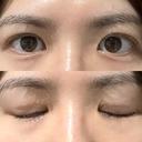 その他（目元） / 自然癒着法 LUHO（ルホ）美容外科 DAY 93 サムネイル用