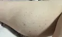 ボトックス（ふくらはぎ） ビューティースキンクリニック 池袋院 DAY 0 サムネイル用