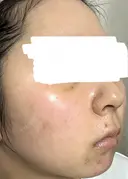 水光注射（ハリ・美肌） ARTE BEAUTY CLINIC DAY 8 サムネイル用