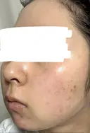 水光注射（ハリ・美肌） ARTE BEAUTY CLINIC DAY 8 サムネイル用