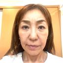 ボトックス（あご） / ボトックス（口角） / ボトックス（眉間） / ボトックス（額） TCB東京中央美容外科 自由が丘院 DAY 0 サムネイル用