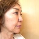 ボトックス（あご） / ボトックス（口角） / ボトックス（眉間） / ボトックス（額） TCB東京中央美容外科 自由が丘院 DAY 0 サムネイル用