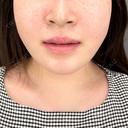 ヒアルロン酸注入（鼻翼基部） ziz CLINIC AFTER サムネイル用