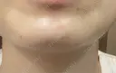 ボトックス（あご） / ボトックス（肩） / ワキ汗治療（ボトックス） / ボトックス（眉間） 共立美容外科 名古屋院 DAY 3 サムネイル用