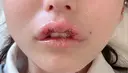 その他（口元） アネシス美容クリニック DAY 2 サムネイル用