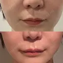 ヒアルロン酸注入（涙袋） / ヒアルロン酸注入（唇） / ボトックス（人中） HAAB×DREAM BEAUTY CLINIC 東京本院 DAY 0 サムネイル用