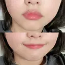 ボトックス（エラ・小顔） / ボトックス（口角） あいちビューティークリニック DAY 5 サムネイル用